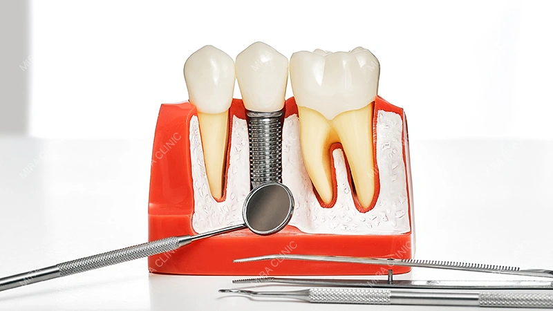 What Is a Dental Crown?